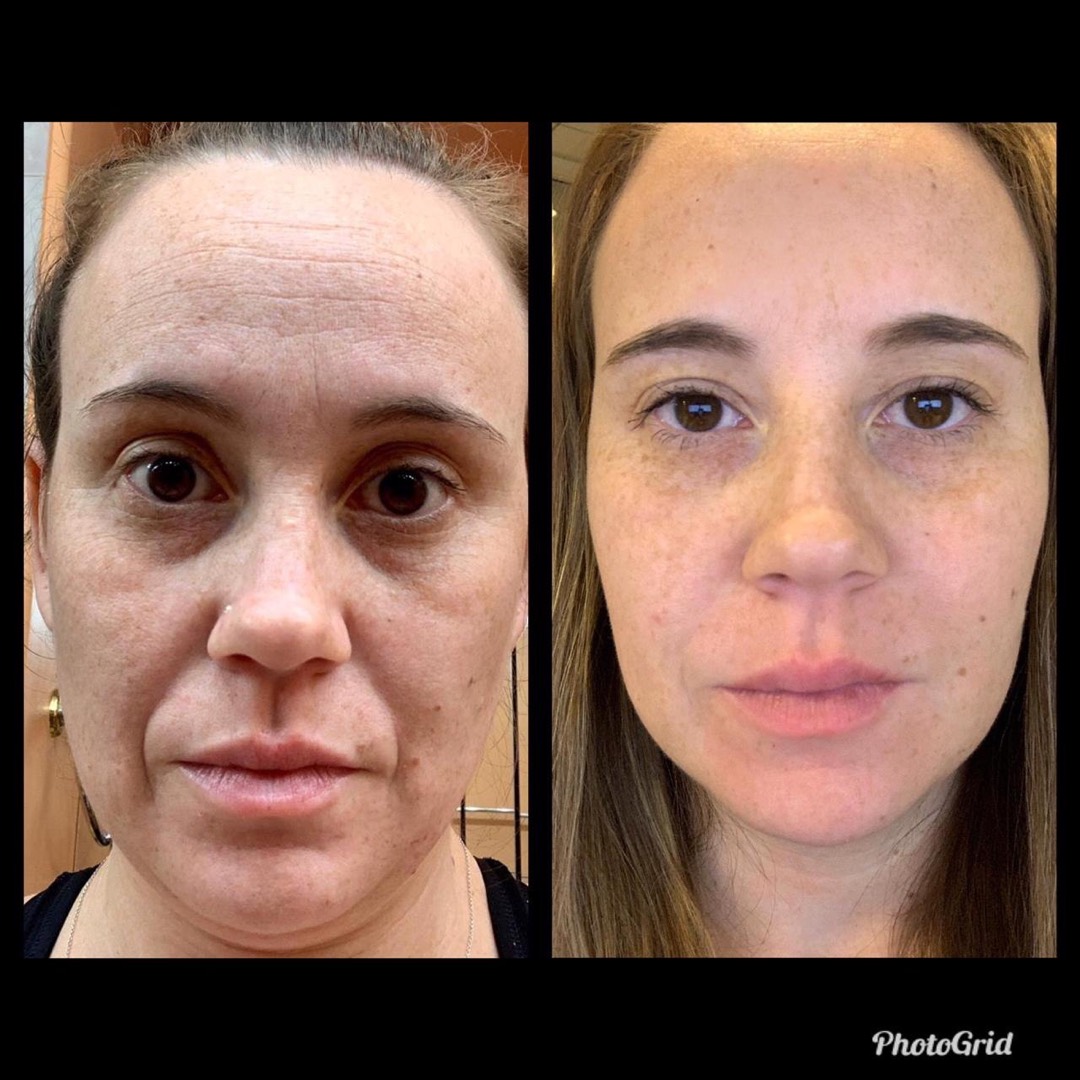 Antes e depois — Clínica Fischer