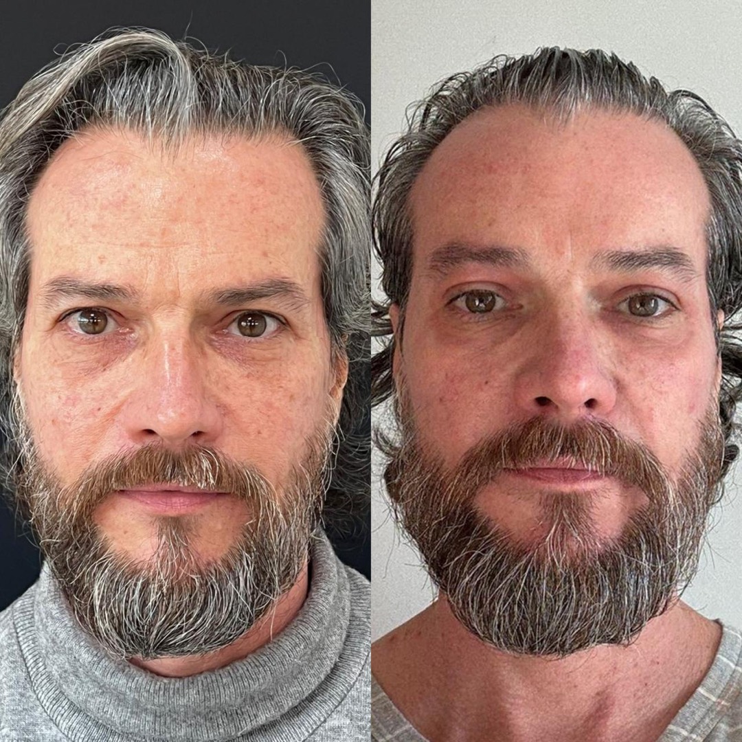 Antes e depois — Clínica Fischer